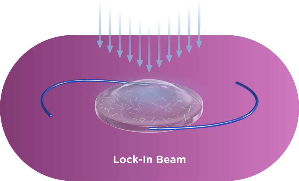 The entire lens is exposed to light to polymerize all the remaining macromers.