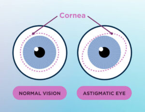 Medical illustration comparing a normal eye and an astigmatic eye, showing the difference in cornea shape with labeled diagrams on a blue gradient background