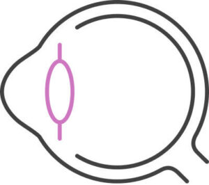 Line art illustration of an eye with a toric intraocular lens depicted in pink, shown from a side/profile angle
